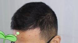 -大麦微针植发丨全国连锁