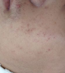 -痘博士北京·全国连锁祛痘机构