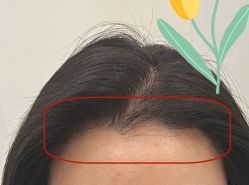 -大麦微针植发全国连锁