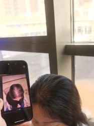 -碧莲盛·不剃发植发