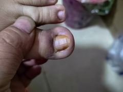 -世龙世家灰指甲鸡眼脚气甲沟炎跖疣护理(通州店)