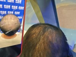 -碧莲盛·不剃发植发