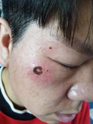 -北京美痣堂古方祛痣斑疣瘊