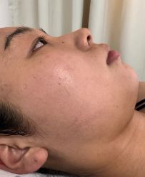 -薇兰专业脱毛连锁机构