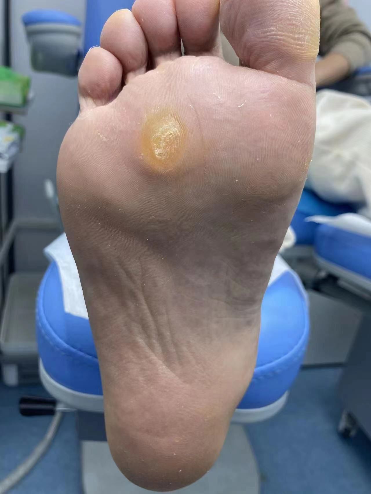 体验了胼胝脚钉治疗