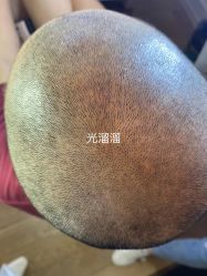 -爱莎扁平疣·汗管瘤·斑痣中心