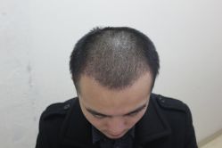 点击看大图 -大麦微针植发丨全国连锁