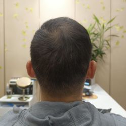 -大麦微针植发全国连锁