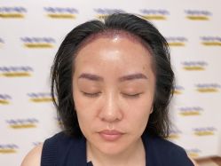 -大麦微针植发全国连锁