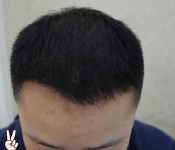 -大麦微针植发丨全国连锁