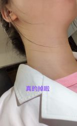 体验后-清疣美疣·痣·斑净肤中心