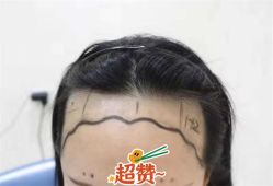 -大麦微针植发全国连锁