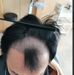 -大麦微针植发丨全国连锁