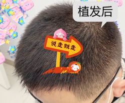 -大麦微针植发全国连锁