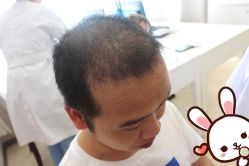 点击看大图 -大麦微针植发丨全国连锁