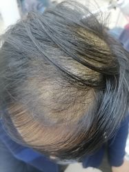 -大麦微针植发全国连锁