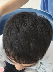 -大麦微针植发丨全国连锁