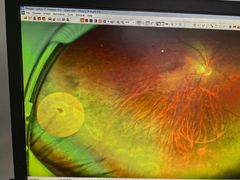 -成都新视界眼科医院·近视手术·儿童近视