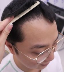 点击看大图 -大麦微针植发全国连锁