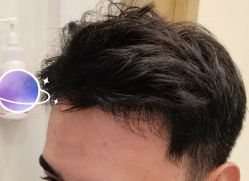 -大麦微针植发丨全国连锁