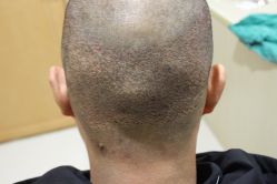 点击看大图 -大麦微针植发丨全国连锁