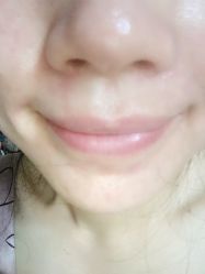 -美丽人生祛斑扁平疣汗管瘤中心