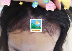 -大麦微针植发全国连锁