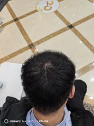 -碧莲盛·不剃发植发