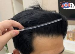 -大麦微针植发丨全国连锁