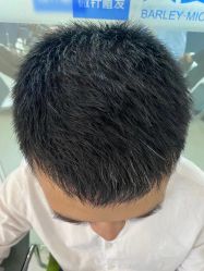 -大麦微针植发全国连锁