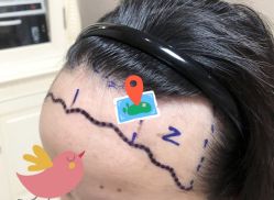 -大麦微针植发全国连锁