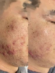 -瓷肌博士·祛痘科技美肤