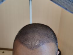 -碧莲盛·不剃发植发