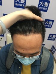 -大麦微针植发丨全国连锁