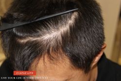 -大麦微针植发丨全国连锁