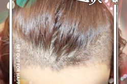 -大麦微针植发全国连锁