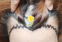 -大麦微针植发全国连锁