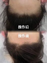 -西施无菌半永久纹绣眉眼影唇轻增发纹发际线
