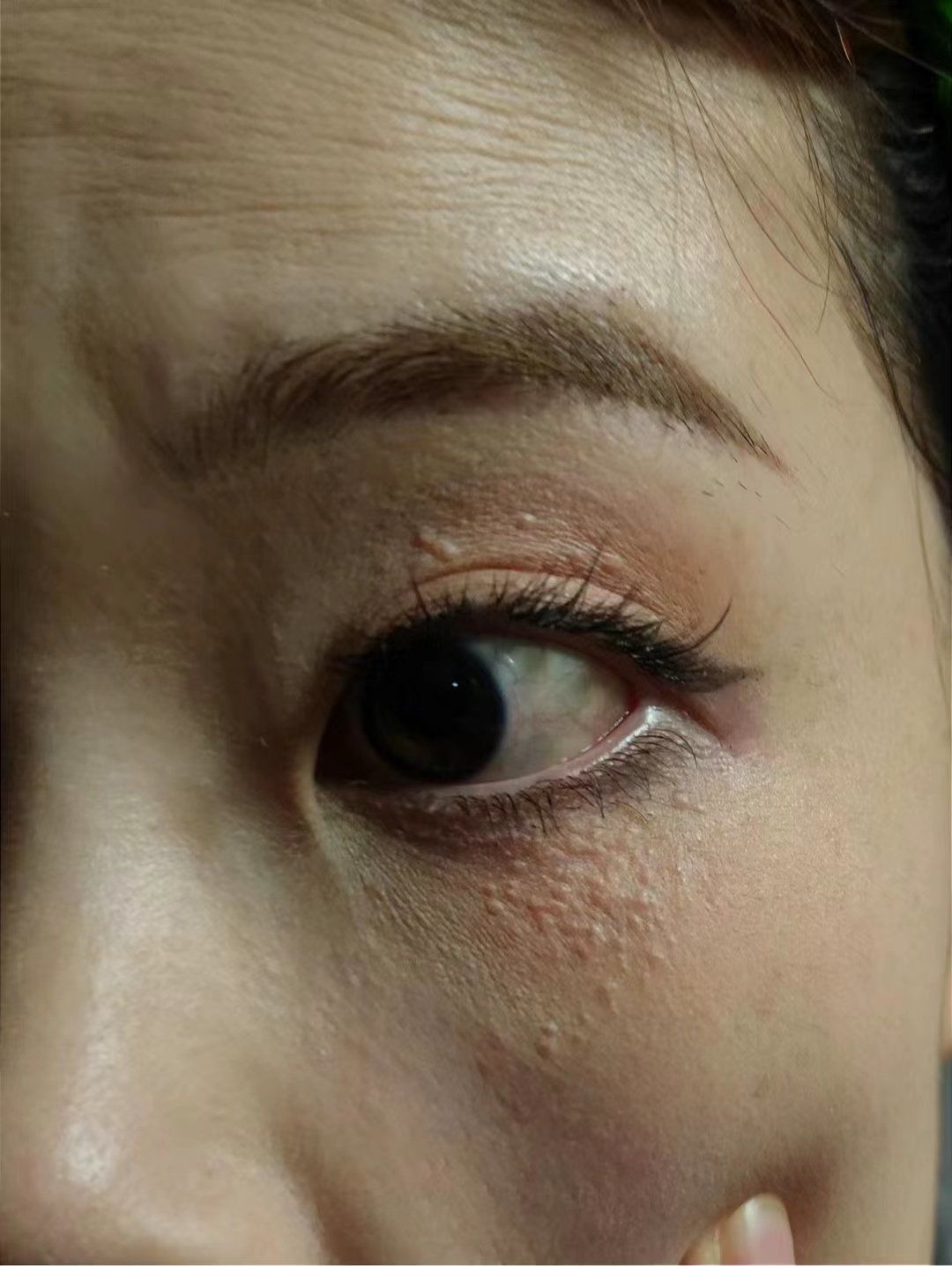 汗管瘤科普:\n眼部汗腺堵塞,影响美观