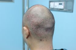 点击看大图 -大麦微针植发丨全国连锁