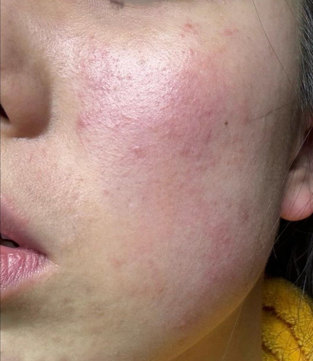 春日皮肤警报:过敏成因大揭秘