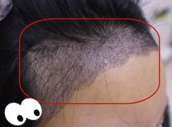 -大麦微针植发全国连锁