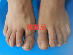 -德哥灰指甲脚气甲沟炎跖疣护理