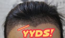 -大麦微针植发丨全国连锁