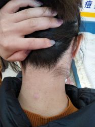 -北京美痣堂古方祛痣斑疣瘊