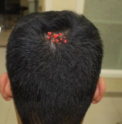 -大麦微针植发丨全国连锁