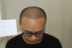 -大麦微针植发丨全国连锁