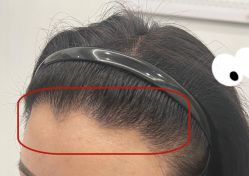 -大麦微针植发全国连锁