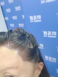 -碧莲盛不剃发植发