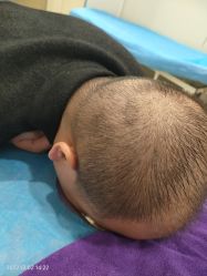 -碧莲盛·不剃发植发